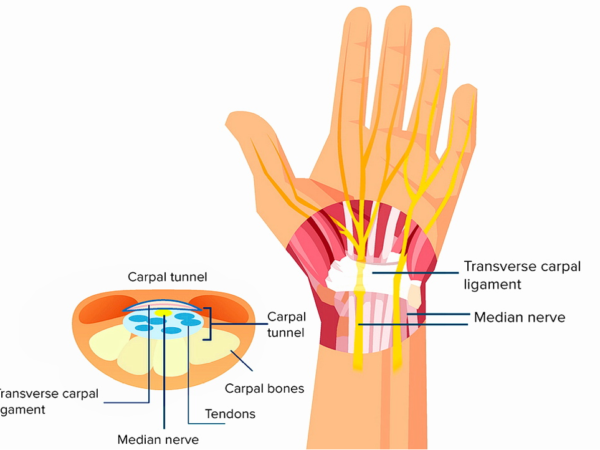 La Sindrome del Tunnel Carpale